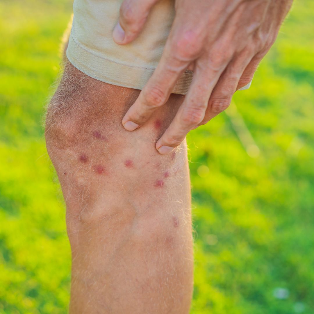 a person with mosquito bites on their knee